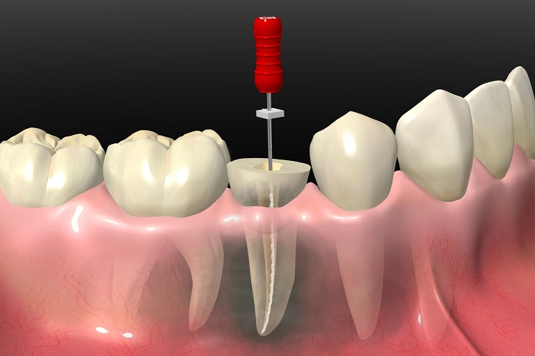 根管治療後ズキズキする 根管治療後に噛むと痛い時の対処法 ながよしデンタルクリニック