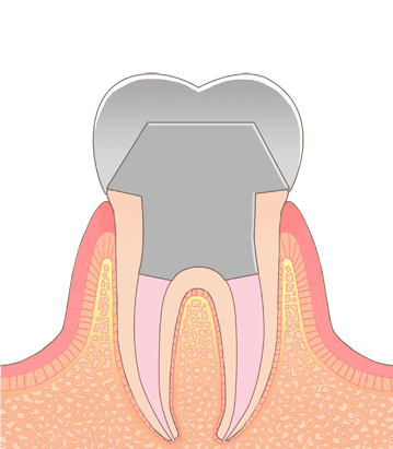 根管治療後ズキズキする 根管治療後に噛むと痛い時の対処法 ながよしデンタルクリニック