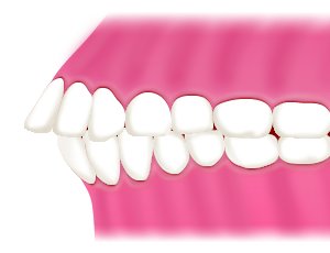 豊中で上顎前突（出っ歯・反っ歯）の矯正を裏側矯正で行うながよしデンタルクリニック