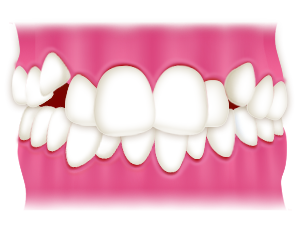 豊中で裏側矯正での叢生（乱ぐい歯、八重歯）の治療なら、ながよしデンタルクリニック