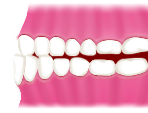 豊中で下顎前突（受け口）の治療を行うマウスピースで行う矯正歯科ならながよしデンタルクリニック