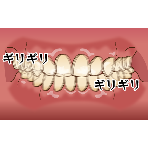 歯ぎしり予防にナイトガードを作製するながよしデンタルクリニック