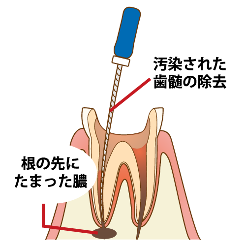 膿による根管治療中の痛み