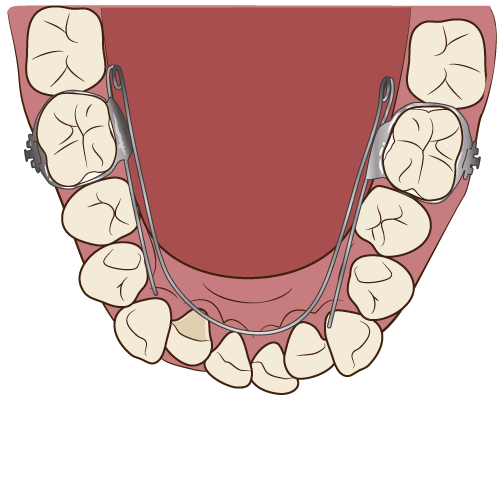 豊中のながよしデンタルクリニックではリンガルアーチを使用した小児矯正を行なっています